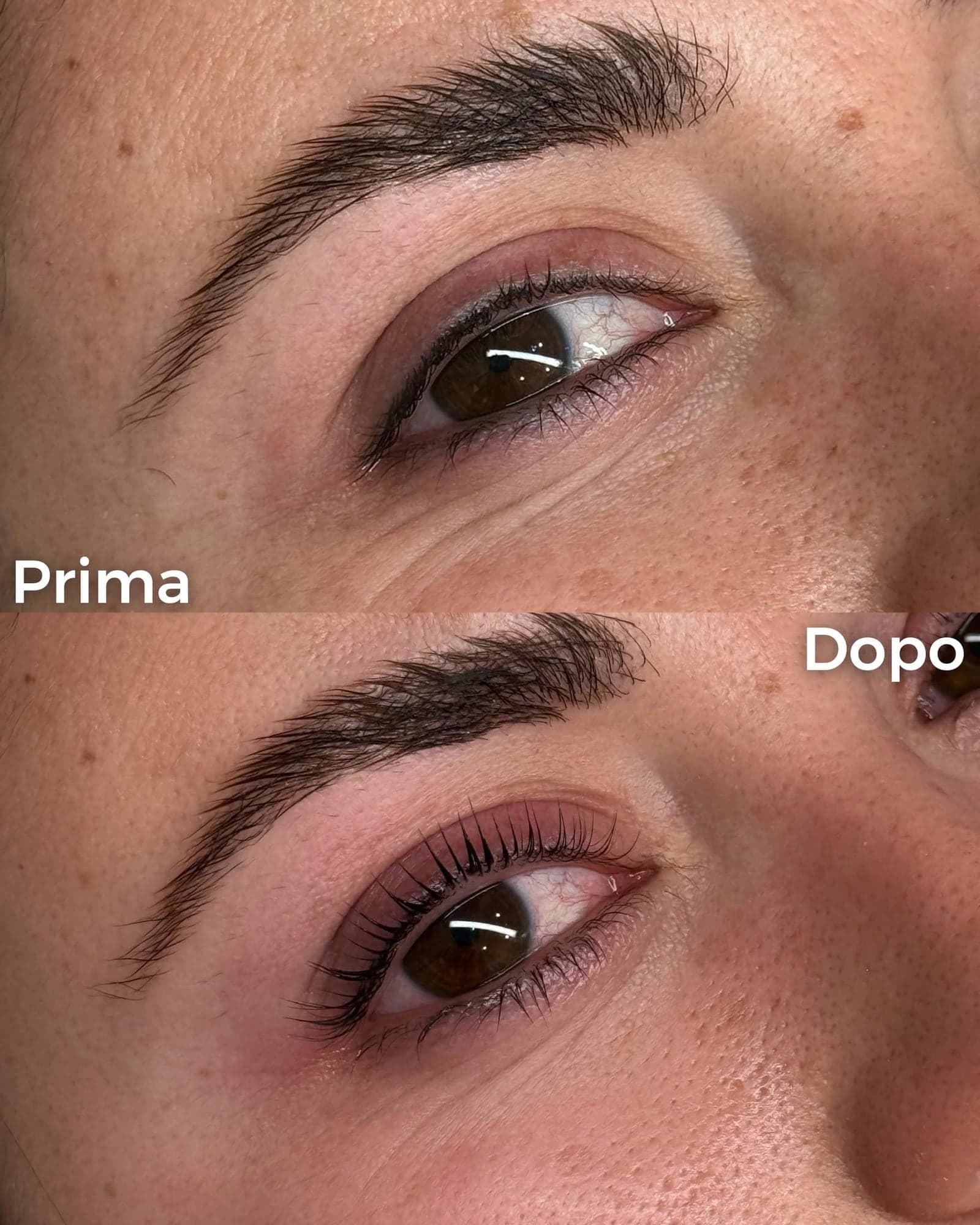 Sopracciglia disordinate prima, pelo pieno e ordinato dopo il brow lift