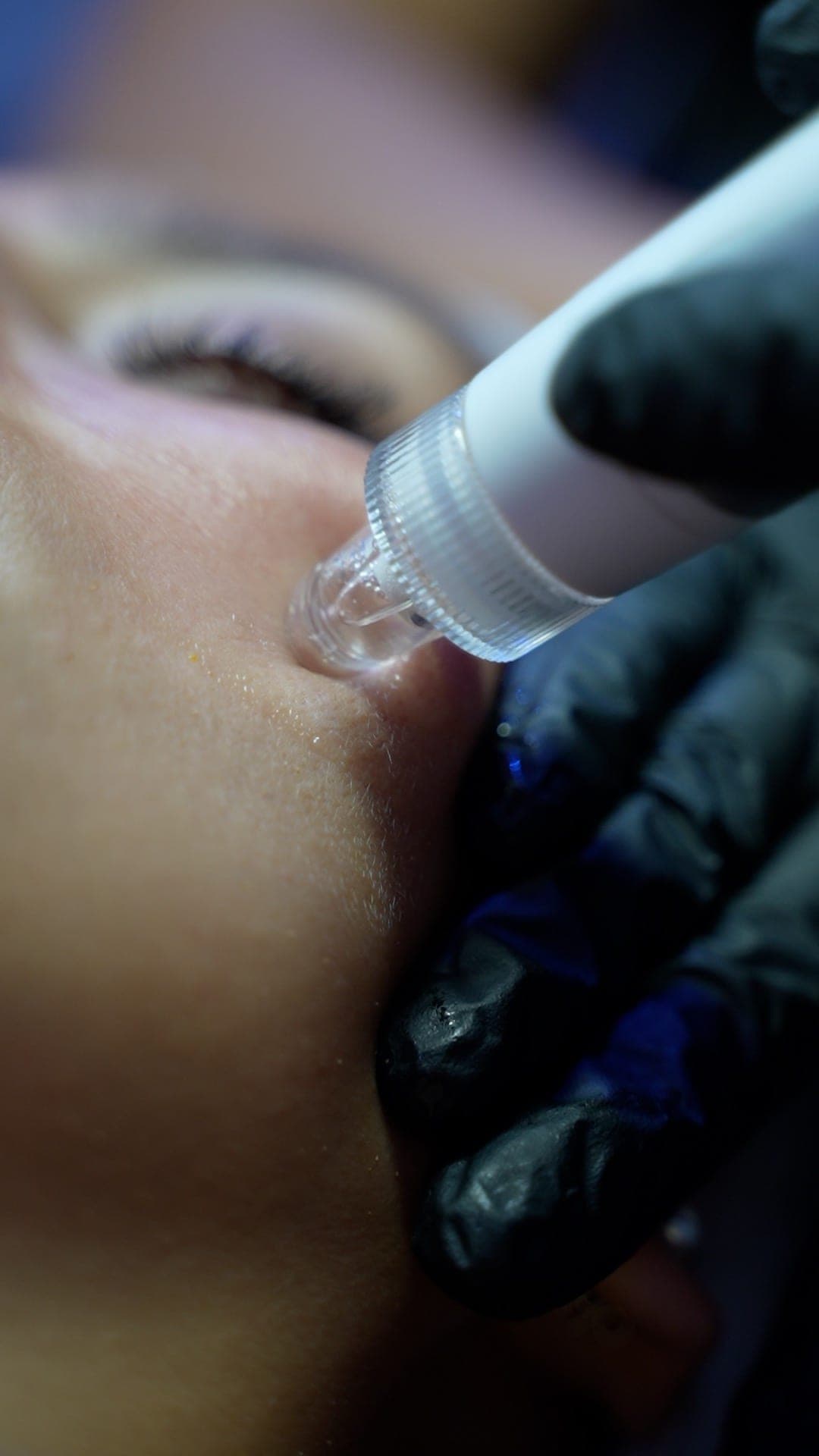 Manipolo per trattamento anti-age sul viso